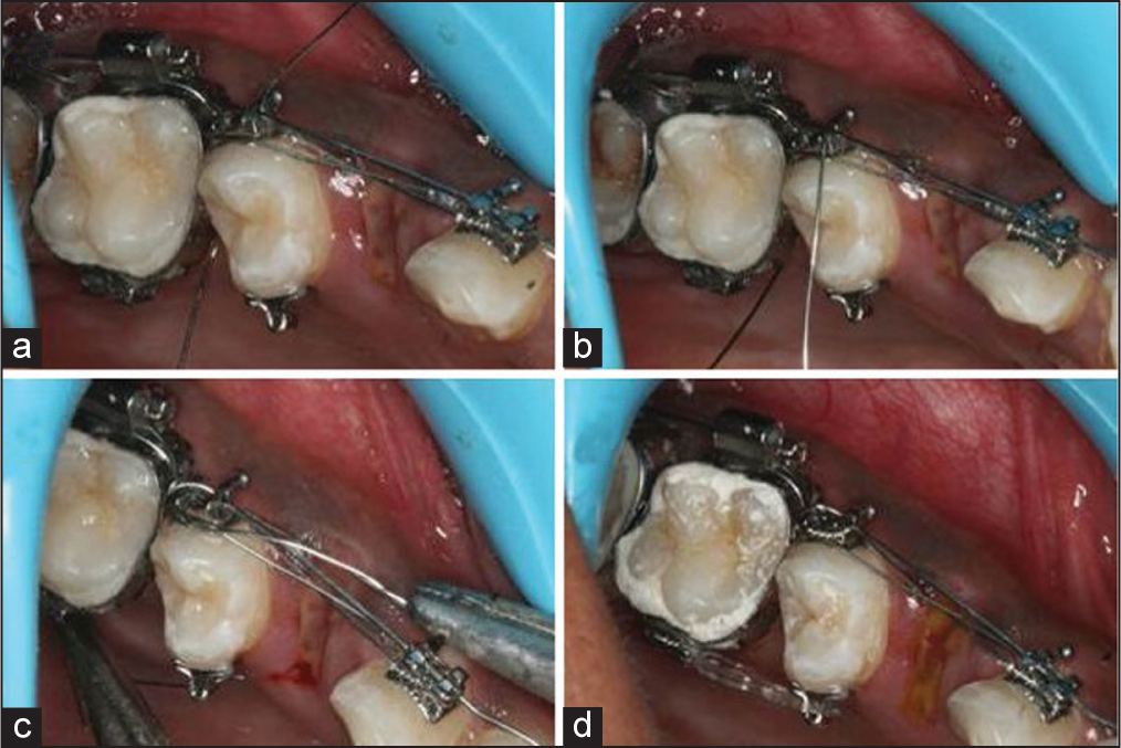 ligature wire is used to engage the archwire in the bracket slot and is ligated into the bracket of a rotated premolar. (a-d) Occlusal view