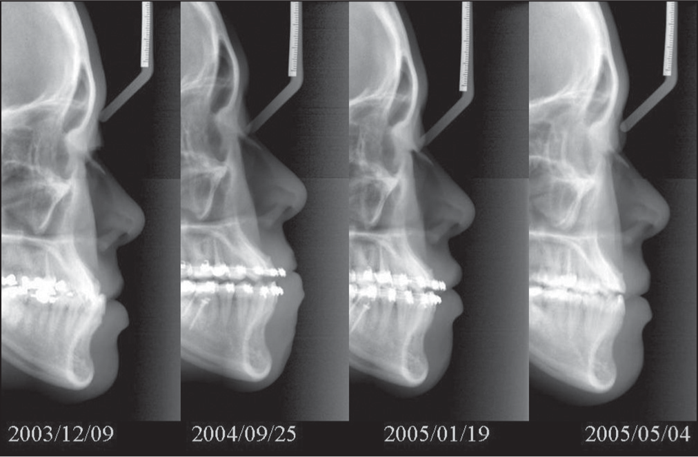 The corresponding cephalograms of the lateral profiles in Figure 6. Correction of anterior crossbite often turned out protrusion in lateral profile, which usually required four bicuspids extraction to retract the profile. With the help of mini-implant anchorage, we can maintain or even improve the lateral profile while the anterior crossbite was corrected in Class III cases