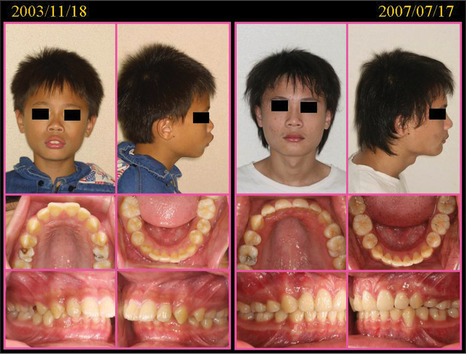 Although the growth potential is good for adolescent patients, which makes the anchorage requirement is not so critical for most adolescent patients, it is still very important for some severe protrusion cases