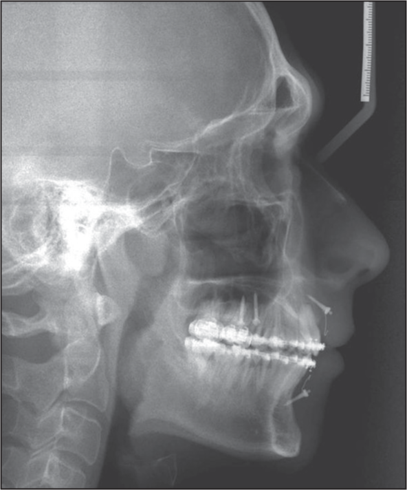 Paradigm shifts in orthodontic treatment with mini-implant anchorage ...