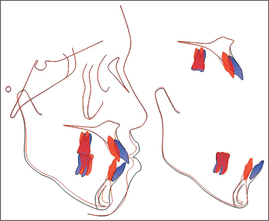 Cephalometric superimpositions showed maximal retraction and overall intrusion on both arches