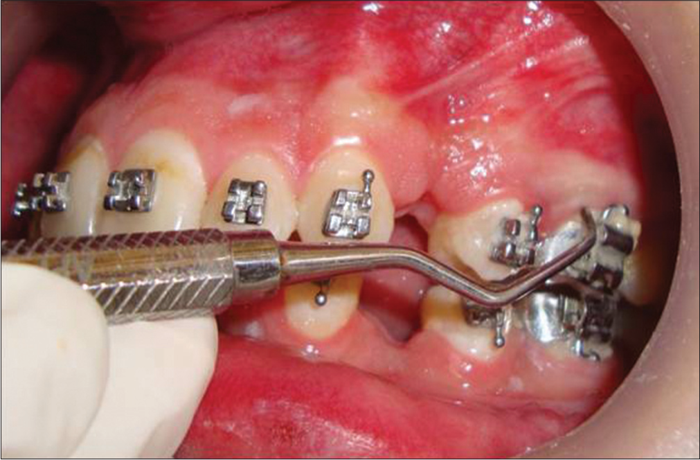 Periodontal curette introduced through the sulcus or pocket orifice during orthodontic treatment