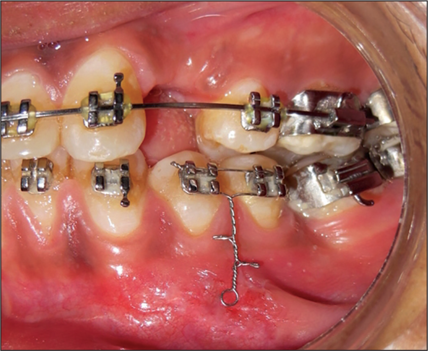 Intra-oral photograph showing the jig ligated to the brackets of the two adjacent teeth with the vertical arm lying in the sulcus between the two teeth