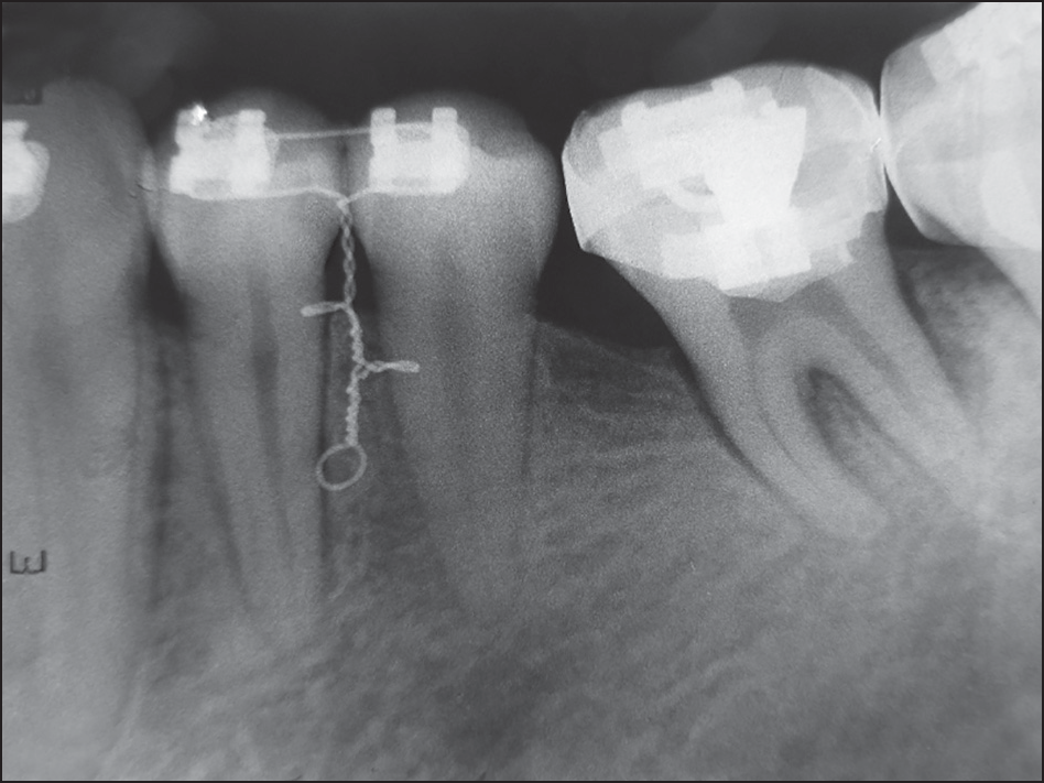 Radiograph taken prior to implant placement
