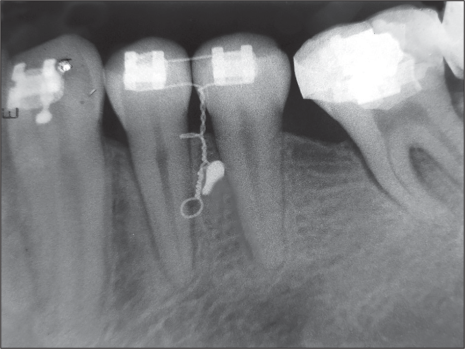 Radiograph taken after implant placement