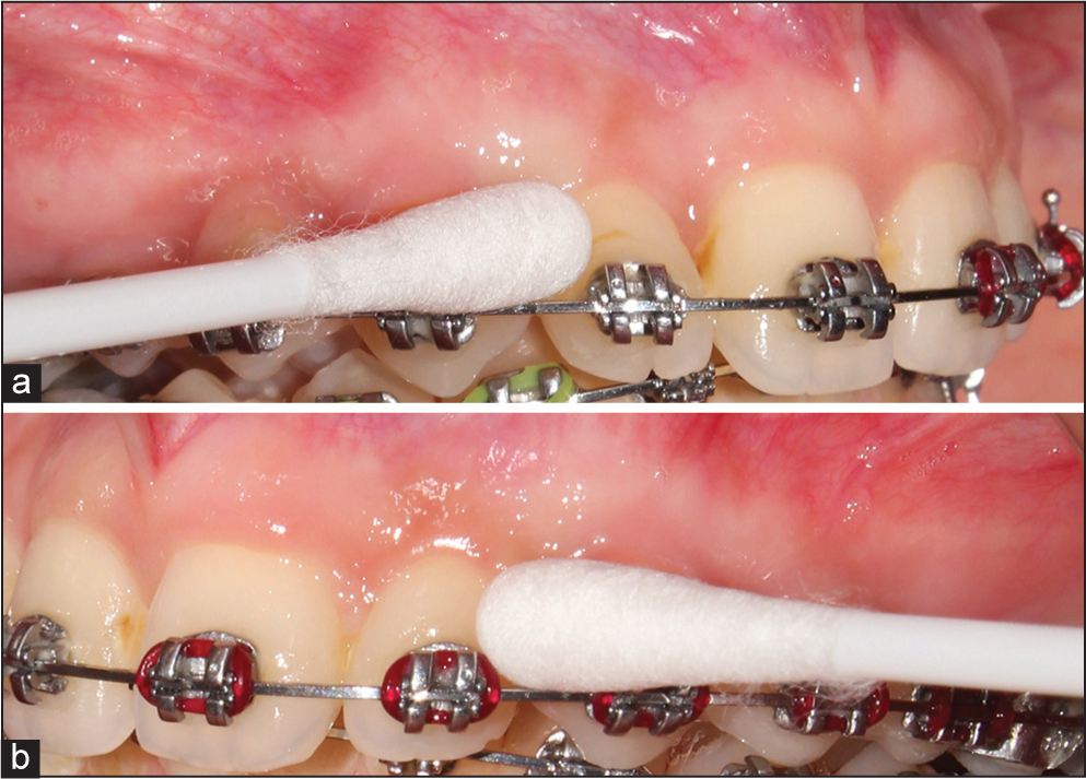 (a and b) Plaque swab collection on maxillary right (self-ligation) and left (conventional ligation with elastomeric modules) hemiarch