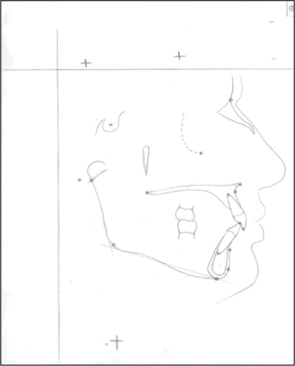 Cephalometric Acetate Tracing Paper