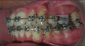 Intraoral picture with modified tiebacks