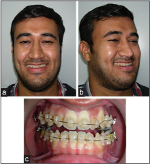 (a) The extraoral smiling view, (b) extraoral oblique view, (c) the frontal intraoral photograph