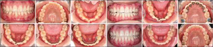 Adult female with a chief complaint of malaligned front teeth due to orthodontic relapse. Treatment time with Incognito™ Lite was 7 months