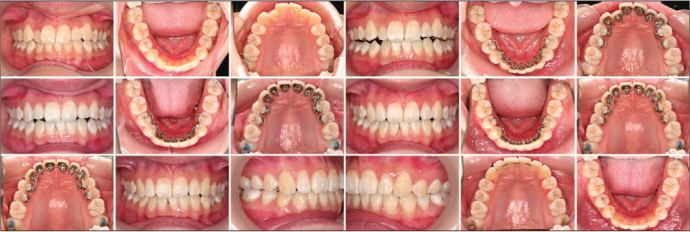 Adult female with a chief complaint of crooked front teeth. She has a missing lower incisor. Treatment plan was with Incognito™ Lite lingual appliance without extraction of any teeth. Notice the presence of the “splinted” premolars brackets for improved stability of posterior teeth and anchorage reinforcement. Treatment time was 9 months