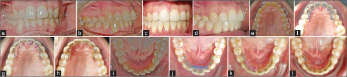 Incognito™ lite lingual orthodontic appliance: Enhancing the scope of  targeted mechanics with customized computer-aided design/computer-aided  manufacturing therapy - APOS Trends in Orthodontics