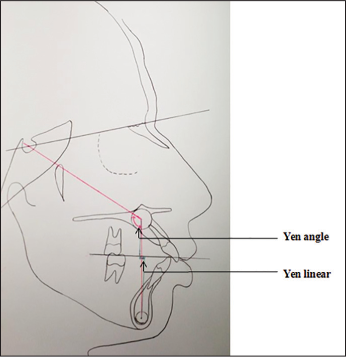 Lateral cephalometric tracing showing Yen angle and Yen linear