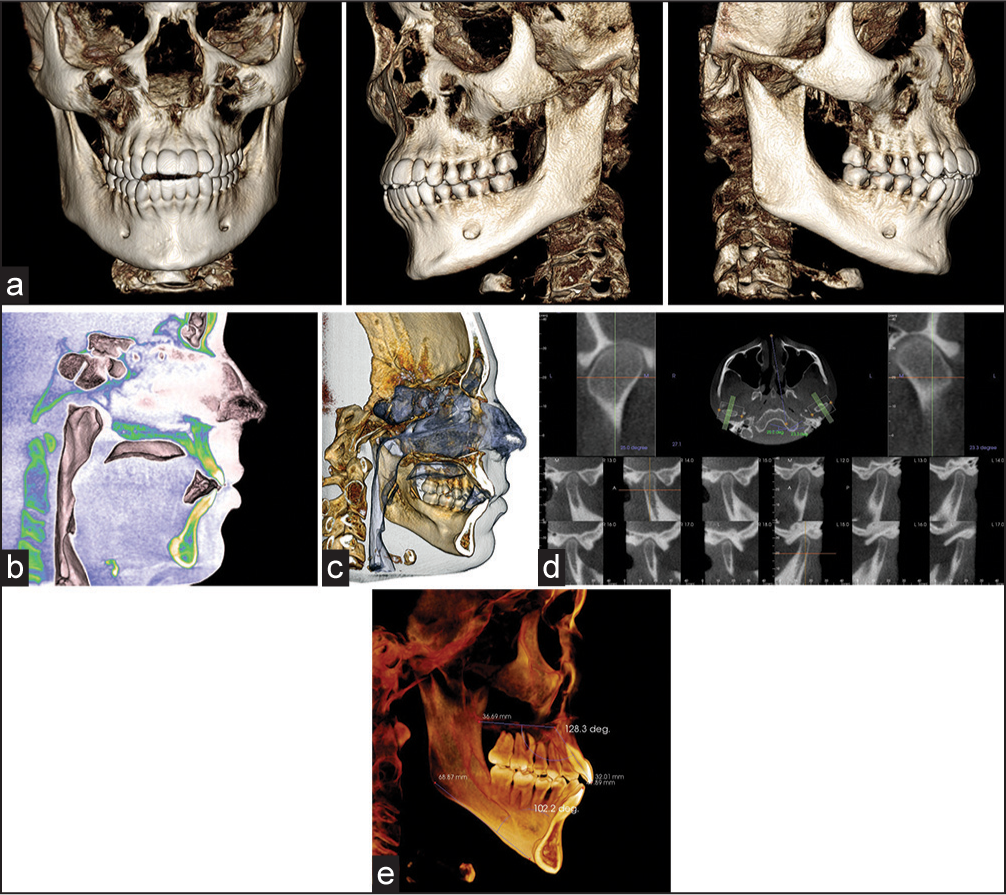 Three-dimensional reconstructions and cross-sections obtained with Invivo5 (Anatomage Inc. San Jose, CA): (a) Dentoalveolar morphology; (b) tongue posture in sagittal clipping; (c) airway view and skeletal morphology in sagittal clipping. See the incisors projection; (d) TMJ in cross-sections (sagittal view); (e) sagittal clipping showing the upper and lower incisors angle related to maxillary and mandibular plane