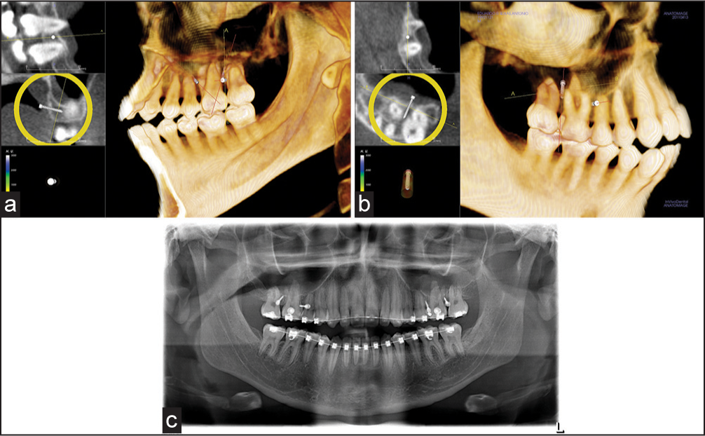 (a) Virtual mini-screw planning obtained with Invivo5 (Anatomage Inc. San Jose, CA) internal view; (b) labial view; (c) panoramic radiography showing the temporary anchorage devices after placement