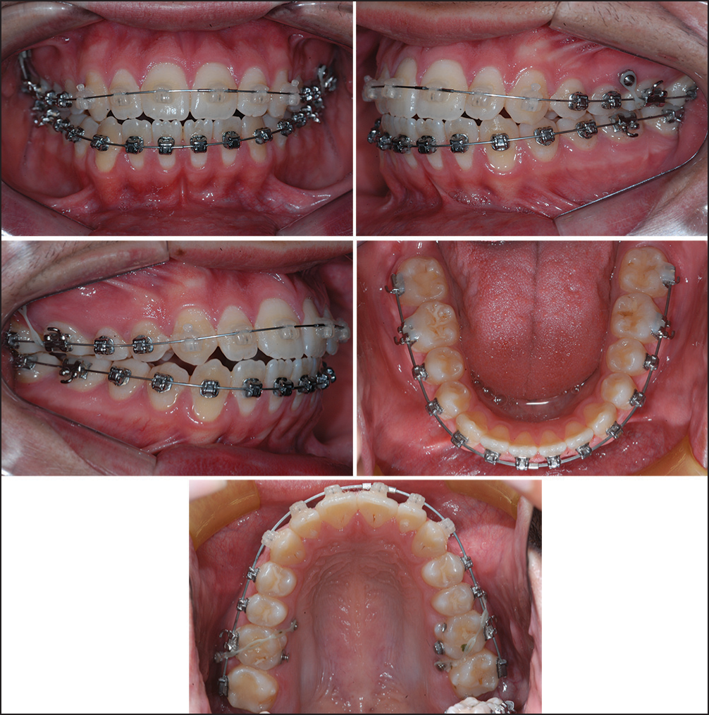 Introral photograph after initial levelling and aligning