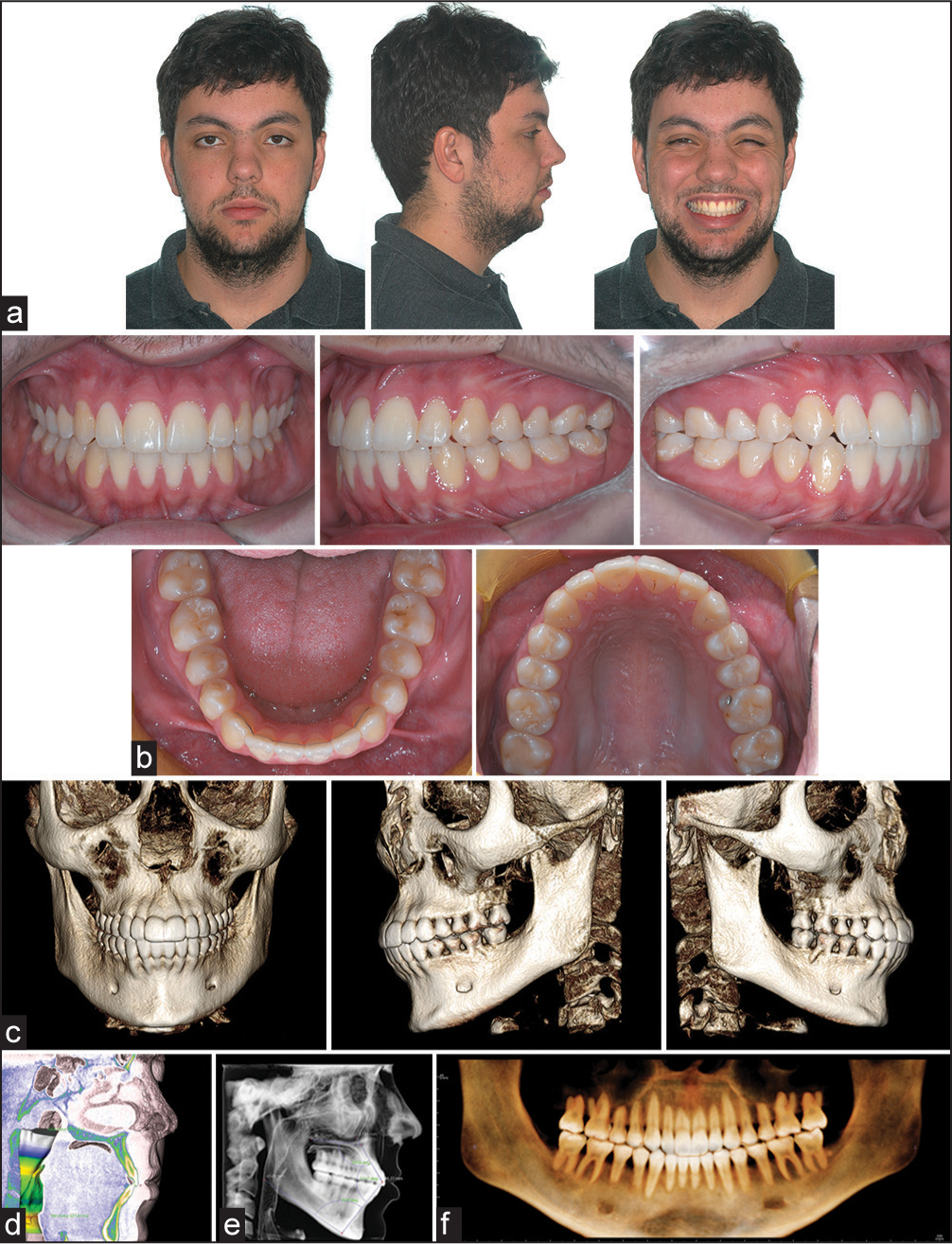 Treatment outcome: (a) Extra-oral pictures; (b) intra-oral pictures; (c) dentoalveolar morphology; (d) tongue posture in sagittal clipping; (e) lateral cephalogram obtained with Invivo5 (Anatomage Inc. San Jose, CA) (f) coronal panoramic view obtained with Invivo5 (Anatomage Inc. San Jose, CA)