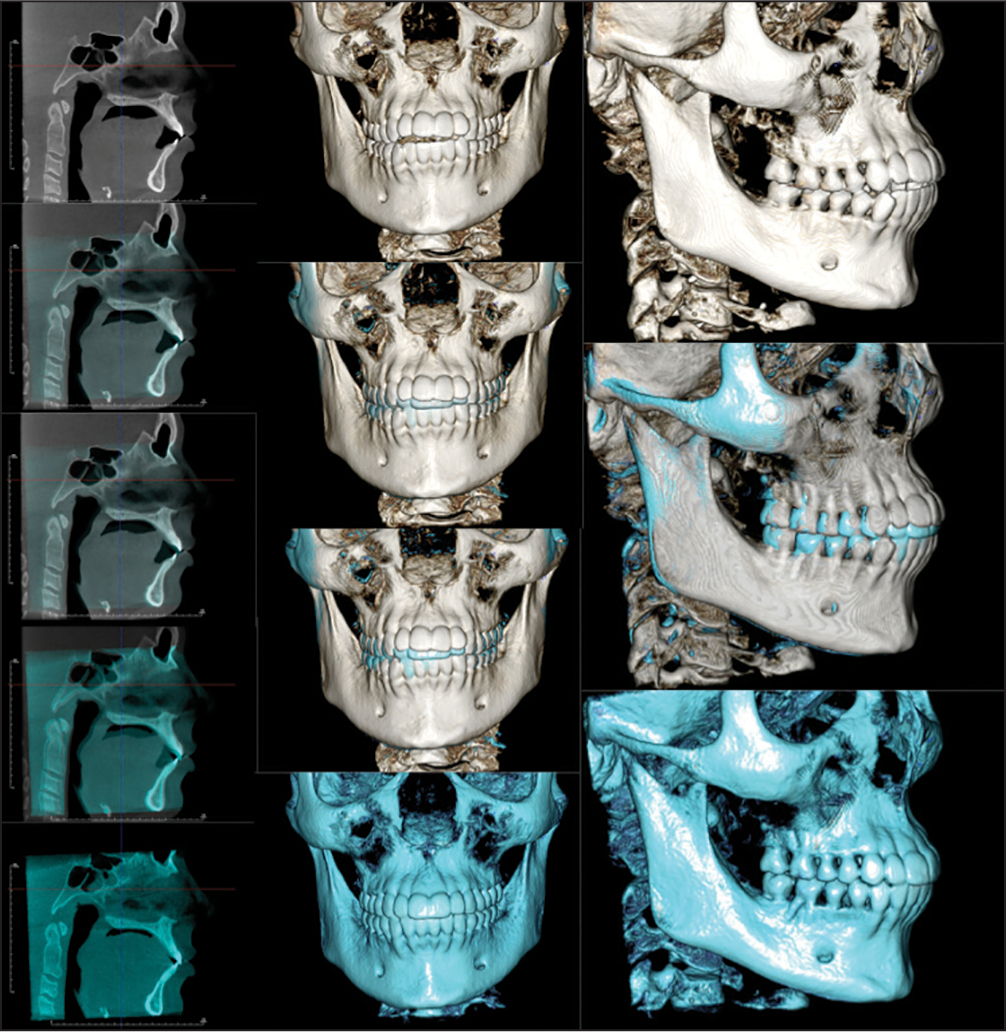 Superimposition obtained with Invivo5 (Anatomage Inc. San Jose, CA)