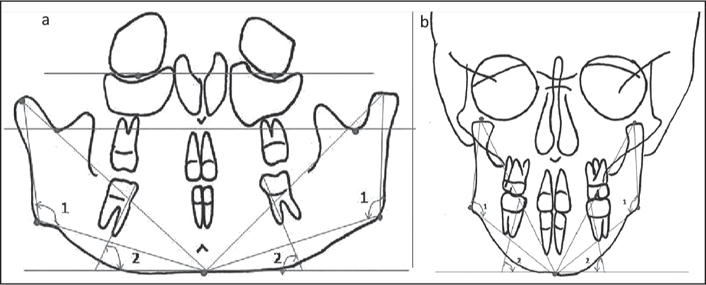 (a) Angular measurements made on orthopantomogram. (1) Gonial angle. (2) Inclination of first molar angulation. (b) Angular measurements made on posteroanterior cephalogram. (1) Gonial angle. (2) Inclination of first molar angulation