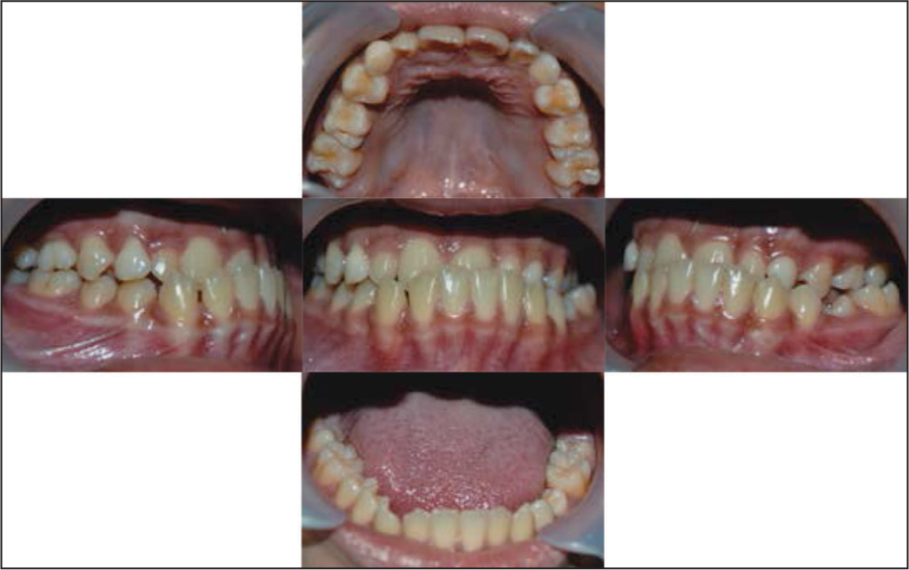 Pretreatment intraoral photographs