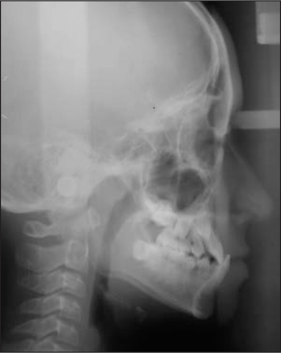 Pretreatment lateral cephalometric radiograph