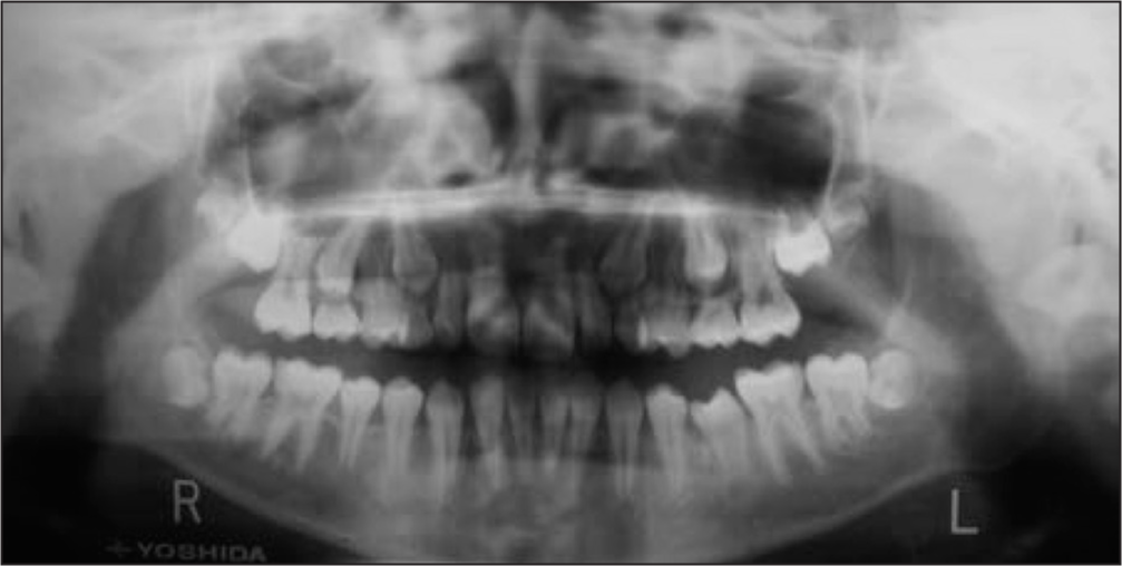 Pretreatment panoramic radiograph