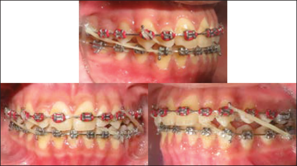 Class III elastic on the right side, anterior diagonal elastic and Class II elastic on the left side