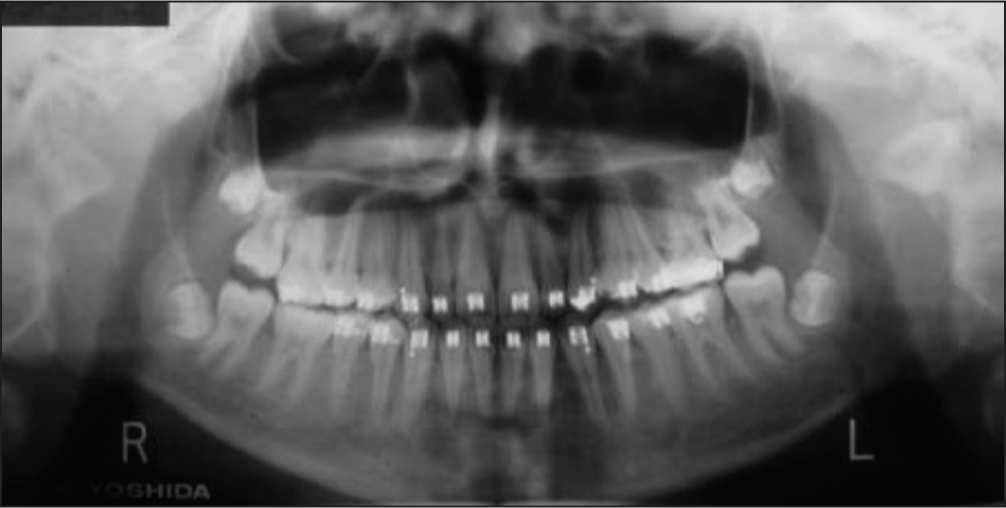 Posttreatment panoramic radiograph