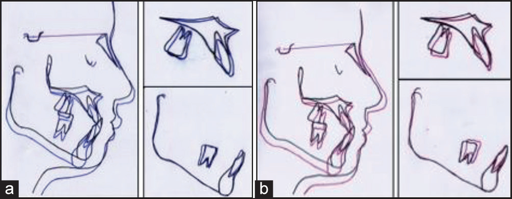 Superimposition of pretreatment and posttreatment tracings, (a) before treatment and after facemask and bonded rapid palatal expander; (b) before treatment and after fixed appliance treatment (Black: before treatment; blue: after facemask and bonded rapid palatal expander; red: after fixed appliance)
