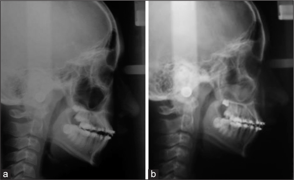 Posttreatment lateral cephalometric radiographs, (a) after facemask and bonded rapid palatal expander treatment; (b) after fixed appliance treatment