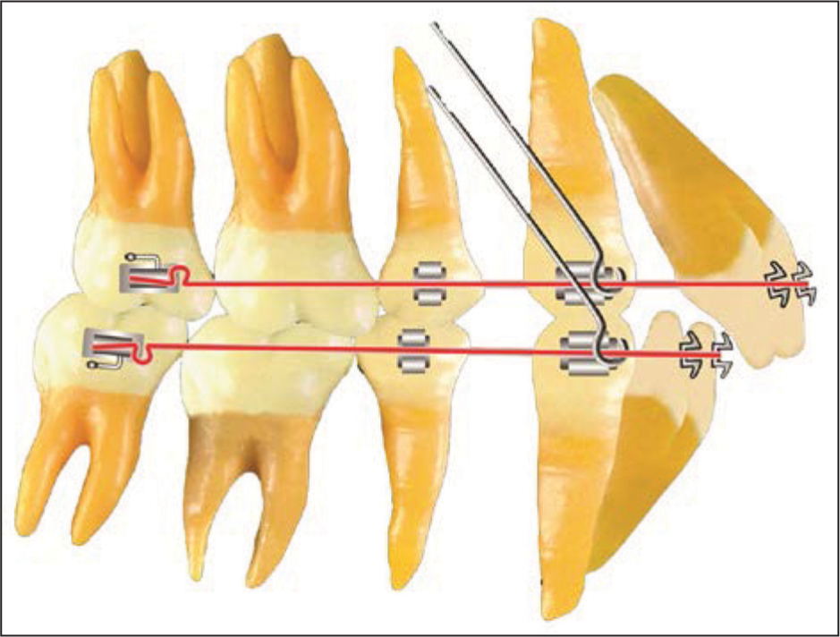 Denture Preparation: Initial arch wires. Initial arch wires consist of a 0.017 × 0.022 inch resilient mandibular arch wire