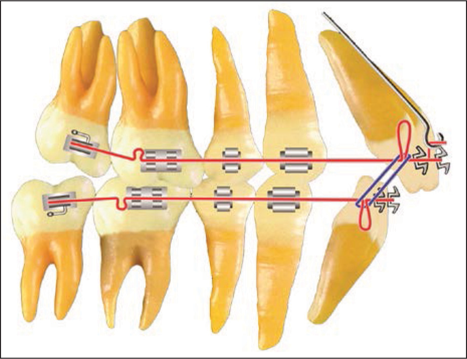 Denture correction: Closing loop application