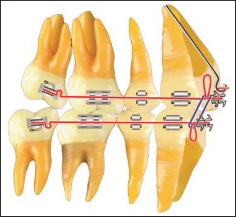 Space closure. After space closure the arch is level