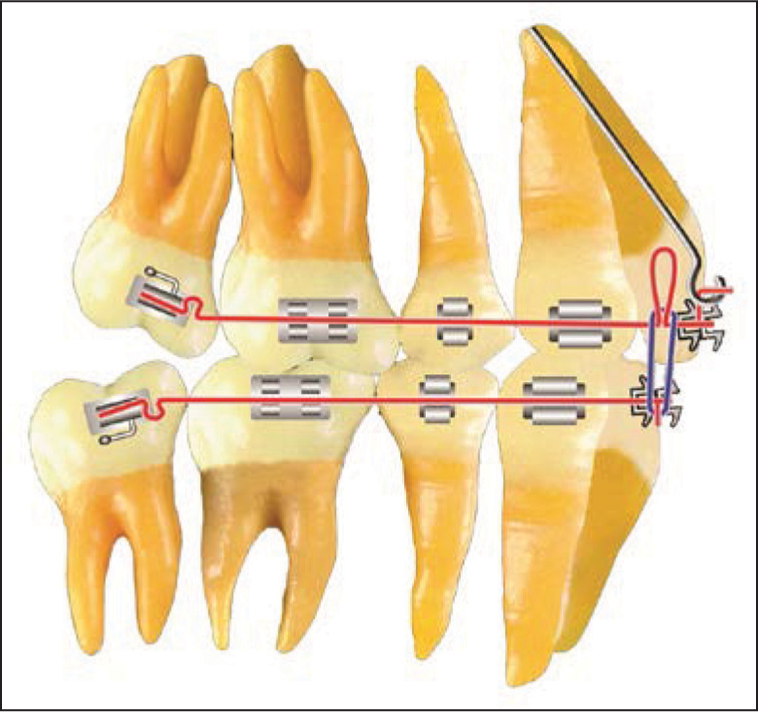 Mandibular anchorage preparation. The second molar is tipped to its anchorage prepared position