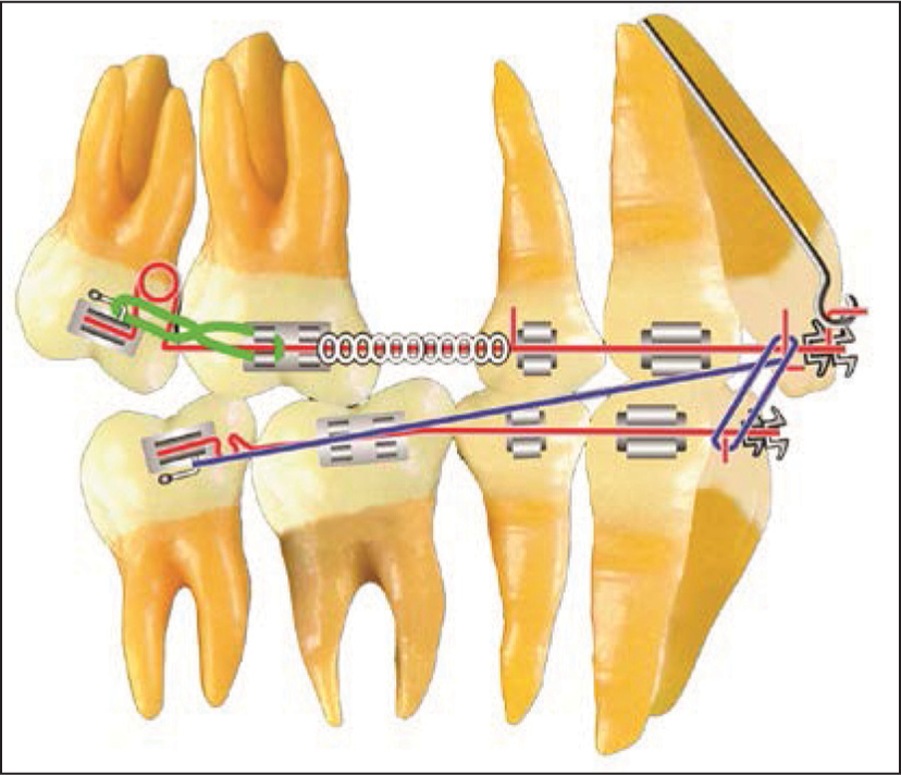 Class II force system. Denture correction: Maxillary first molar distalization