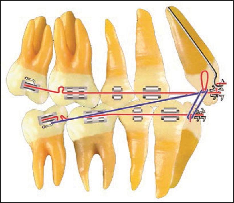 Class II force system. Denture correction: Maxillary anterior space closure