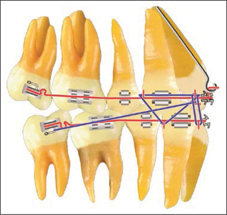 Denture completion. Maxillary and mandibular stabilizing wires, along with the proper elastics and headgear force, are used to complete the orthodontic treatment