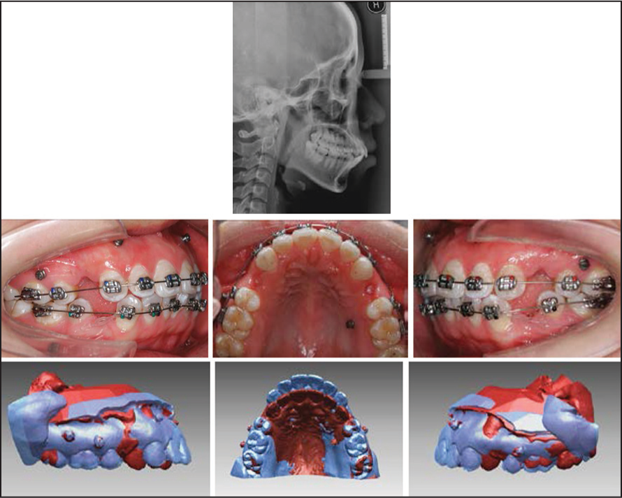 Adult bimaxillary protrusion treated with four premolar extraction and miniscrew anchorage. Superimposition at the miniscrew interface sows retraction of incisors with no anchor loss