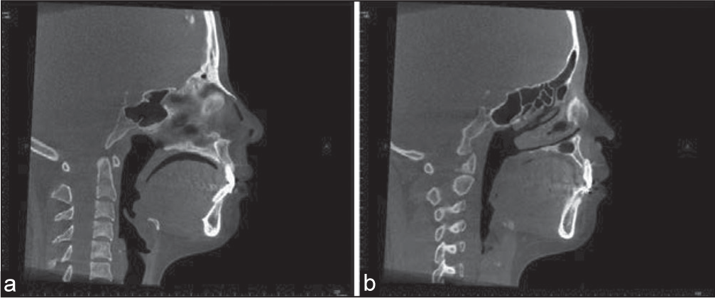 (a) After retraction of incisors with miniscrew implant, alveolar bone of both upper and lower central incisors lost on lingual sides and upper central incisor root apex resorbed; (b) Alveolar fenestration of upper lateral incisor root