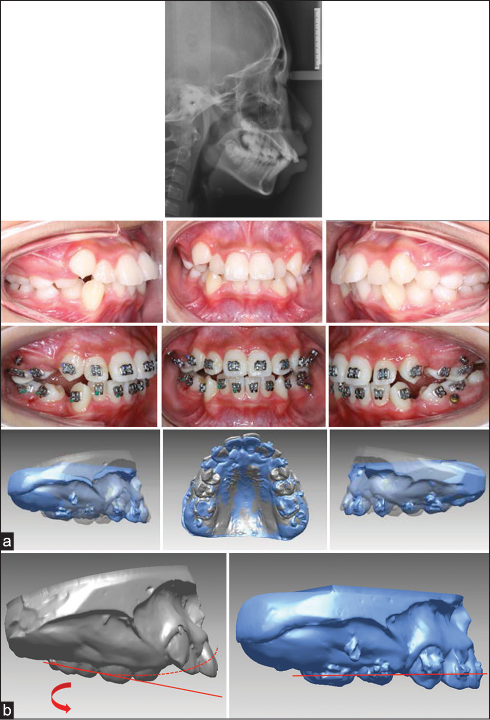 (a) 12-year-old high angle Class II case. Upper molars tipped forward in 2 months even with mini-screw implants as anchorage. (b) Engagement of 0.014˝ nickel titanium wire resulted in the molar anchor loss