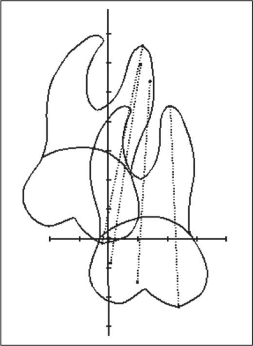 Upper molar growth pattern traced using American metallic implant growth sample. The initial observation age is 8.5 and the last is 15.5; between them are 10.5 and 12.5, respectively. One unit of scale equals 2 mm. Horizontal frame of reference is Downs occlusal plane