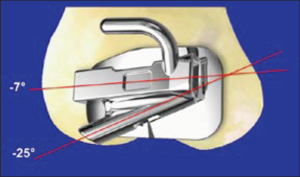 The cross buccal tube designed to prevent physiologic anchorage loss