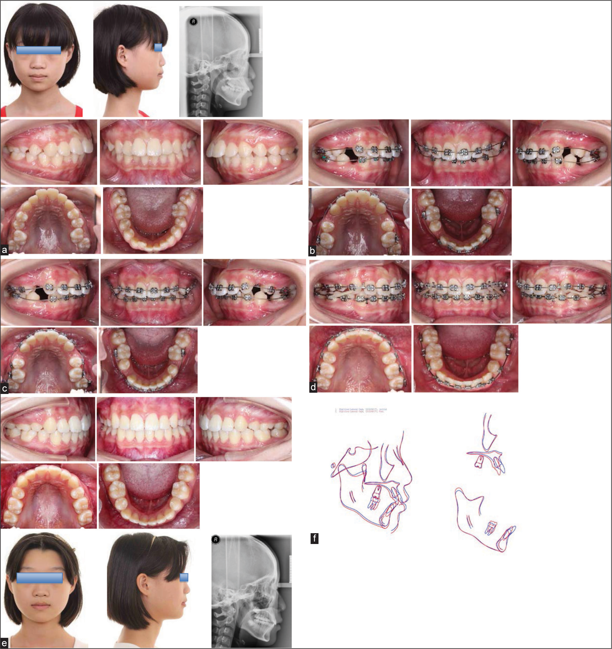 A Class II protrusion case treated with PAC technique