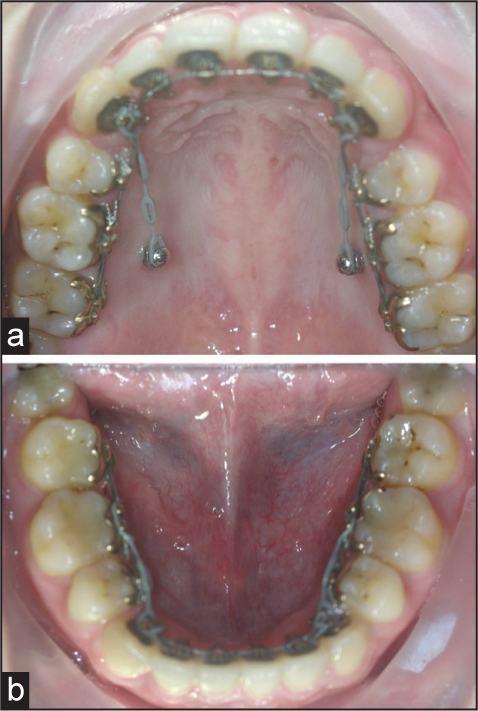 (a and b) Intraoral photographs with temporary anchorage devices