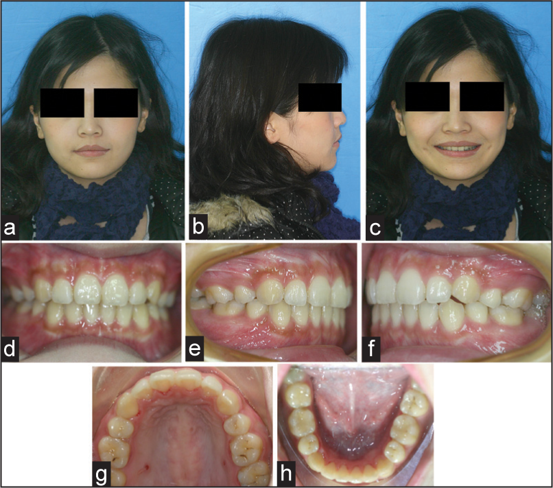 (a-h) Posttreatment extraoral and intraoal photographs