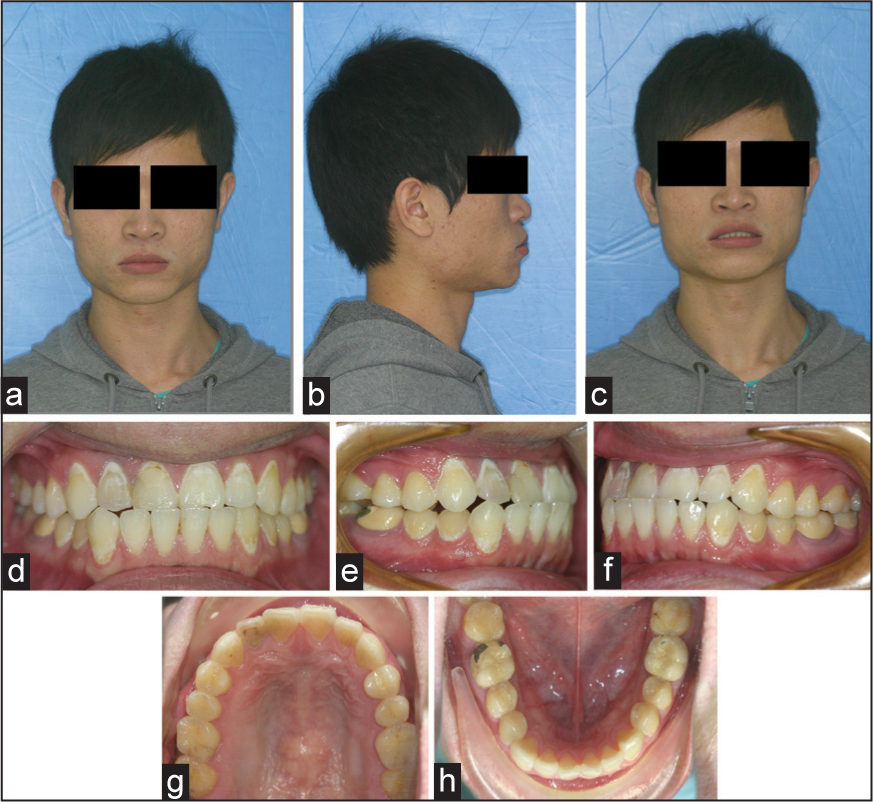 (a-h) Pretreatment extraoral and intraoal photographs