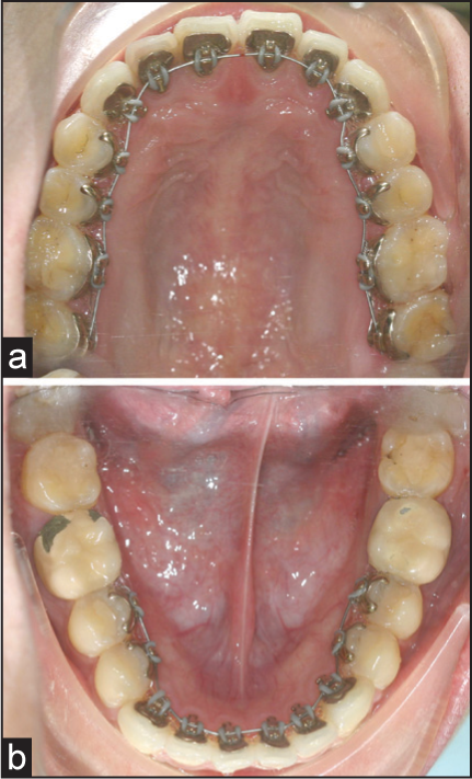 (a and b) Intraoral photographs with appliance