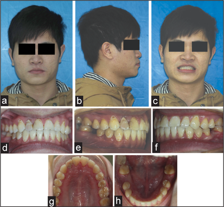 (a-h) Posttreatment extraoral and intraoal photographs