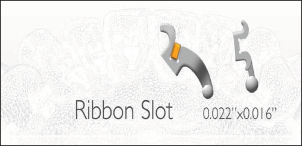 Ribbon arch slot 0.022” × 0.016” with vertical insertion in anteriors and horizontal insertion in posteriors
