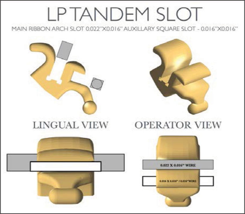 Low profile tandem slot main ribbon arch slot 0.022” × 0.016” auxillary square slot - 0.016” × 0.016”